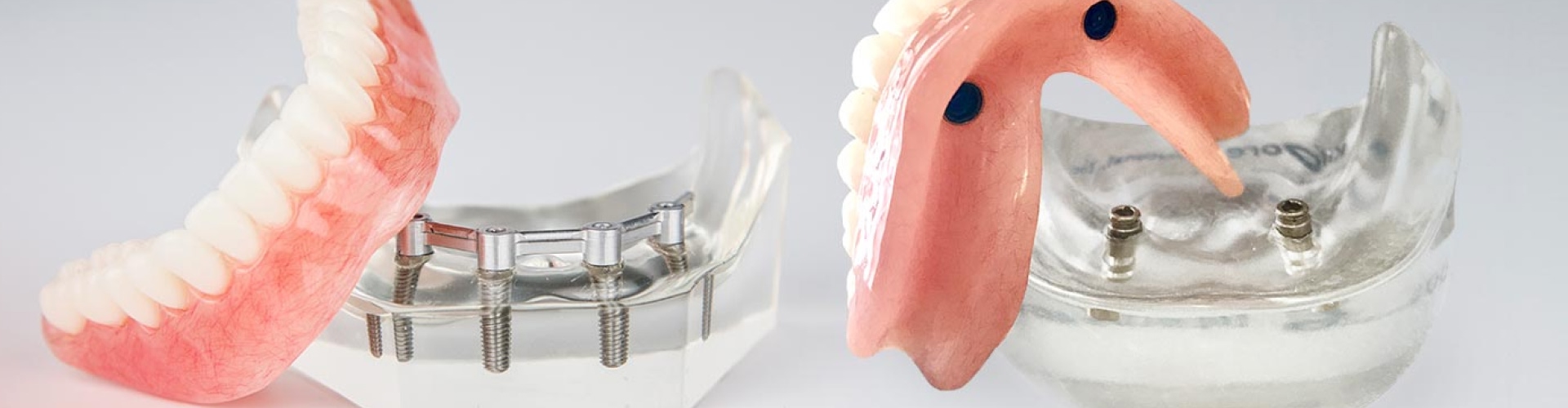 Lower and upper implant-retained dentures leaning against acrylic jaw models.